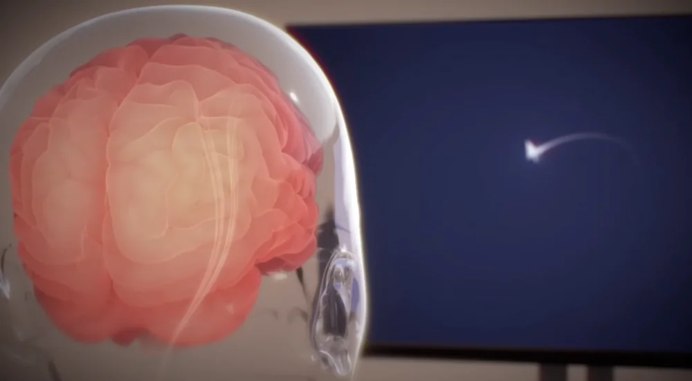 Neuralink Ілона Маска вперше визнала проблеми з імплантованим у мозок людини чіпом